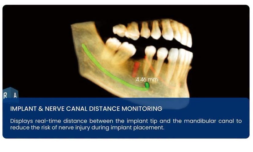 3D implant plan showing live distance measurement to the mandibular canal